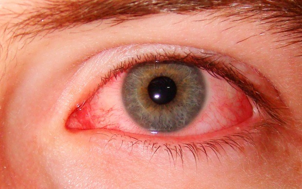 Красные глаза зуд причины и лечение